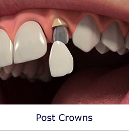 Post Crowns